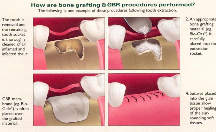 bone graft ---