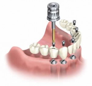 Permanent_Dental_Bridge